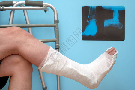 蓝色背景上有断腿的男人的腿踝关节骨折踝关节骨折的X射线图像背景图片