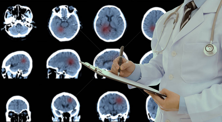 医生诊断图象有菌扫描脑部脑内出血和肿图片