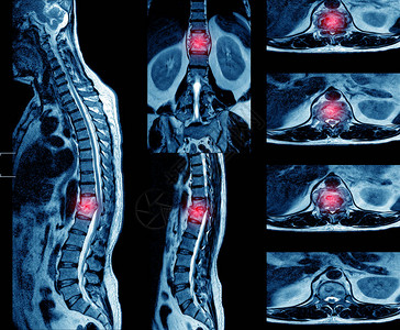 胸椎MRI这些发现提示T1112水平的结核脊椎盘炎伴骨内脓肿形成图片