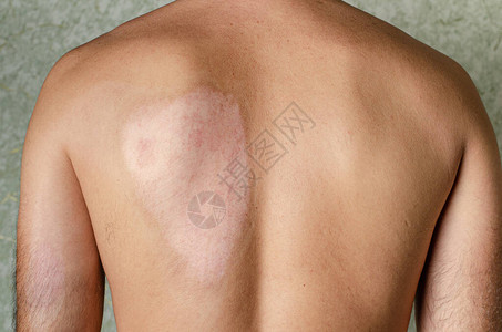 二级皮肤烧伤男背部后愈合的汽车医图片