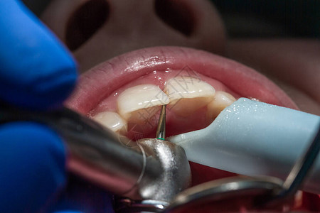 门牙治疗龋齿牙齿检查图片