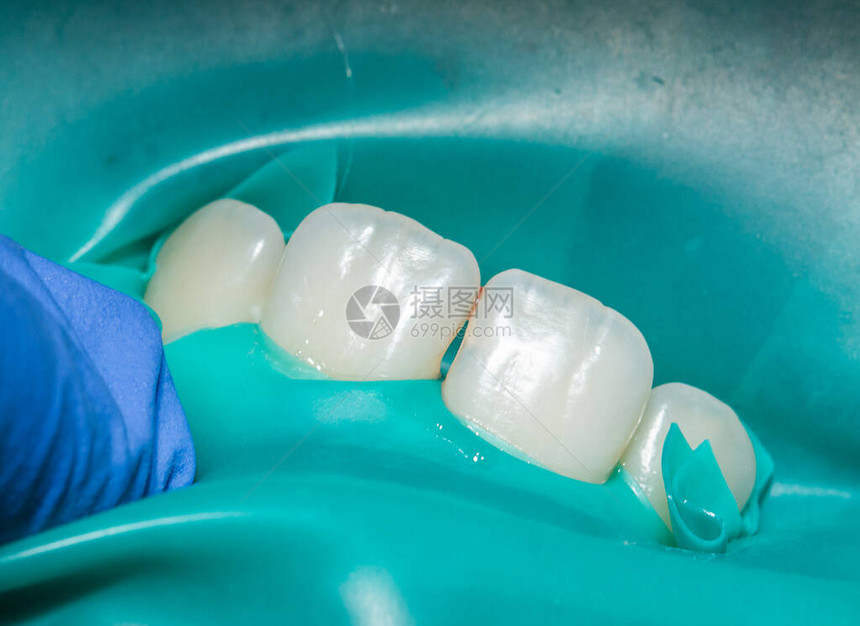 牙科医前牙检查和治疗图片