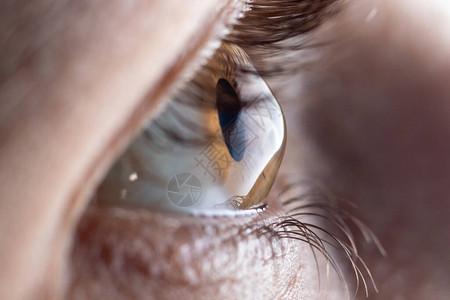 宏观眼睛照片圆锥角膜眼部疾病图片