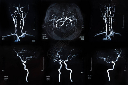 脑中风和脑血管疾病磁共振成像图片