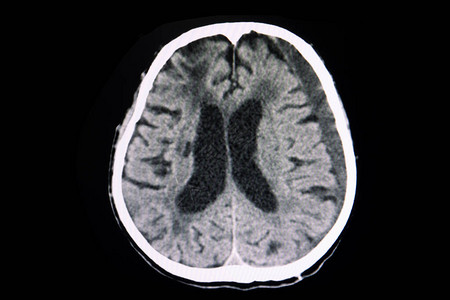 一名有轻度颅脑外伤病史1个月的患者的CT脑部扫描显示左侧大脑半球有大面积的急背景