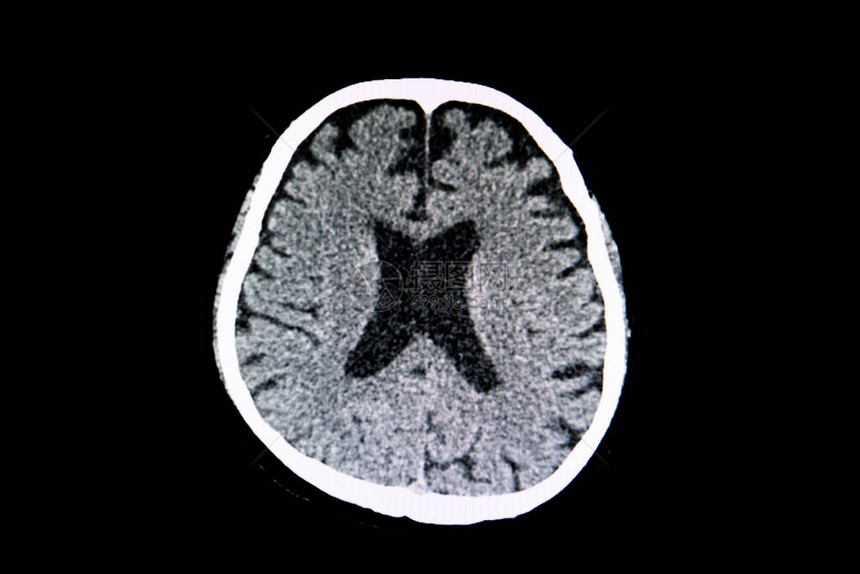 脑萎缩患者的大脑CT扫描显示脑室大且脑图片