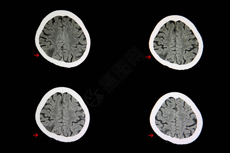 脑梗死病人的脑部CT扫描显示右对子区域有微弱的皮高清图片