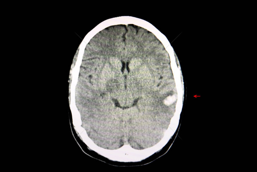 对一个因车祸而出血的脑部进行CT扫描图片