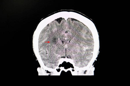 脑部CT扫描与注射在中风病人身上的对比介质对照媒体图片