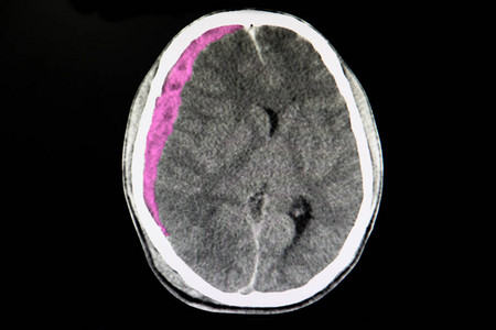 对一名交通事故患者的脑部进行CT扫描显示他患有急图片