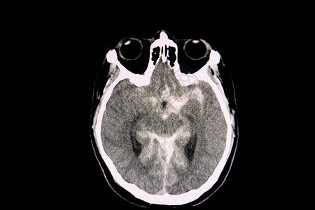 对一名交通事故病人的脑部进行CT扫描图片