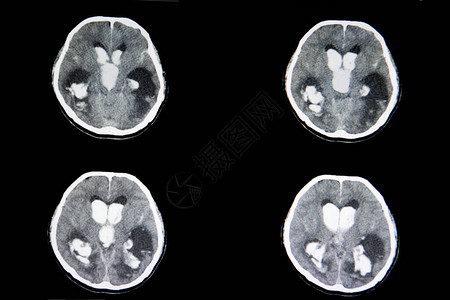 出血中风导致颅内大出血患者的大脑CT扫描在侧图片