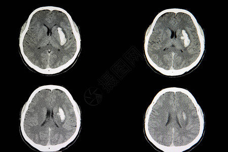 出血中风导致颅内大出血患者的大脑CT扫描左侧大脑图片