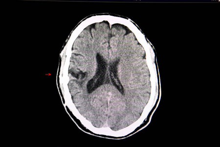 肩凝症对先前进行过颅骨切除术和最近因车祸脑出血的患者的大脑进行CT扫描到手术颅骨背景