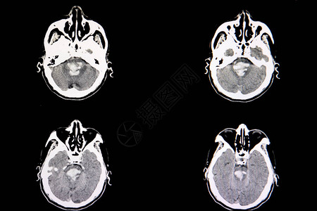 对脑部进行CT扫描图片