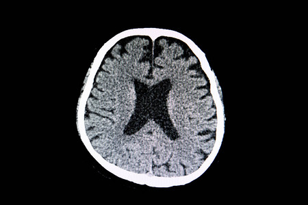 脑萎缩患者的大脑CT扫描显示脑室大且脑高清图片