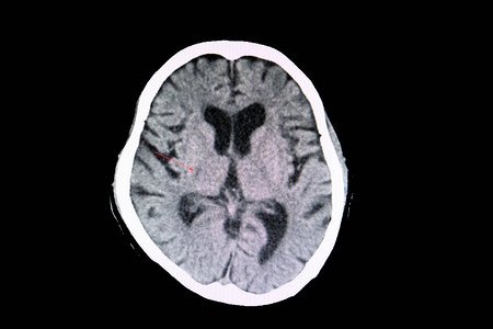 脑梗塞病人的脑部CT扫描显示一小片疏漏裂图片