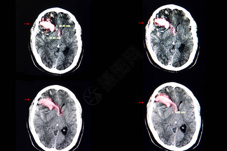在右前方有大血凝块的血栓状脑部脑部CT扫描从腹腔图片