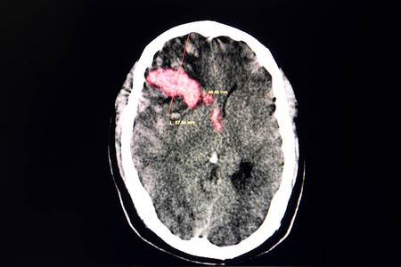 肩凝症在右前方有大血凝块的血栓状脑部脑部CT扫描从腹腔背景