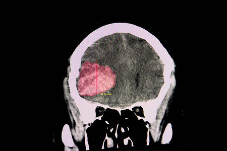肩凝症在右前方有大血凝块的血栓状脑部脑部CT扫描从腹腔背景