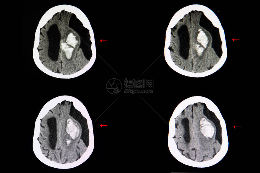 在左脑半球也发现了一个大型的亚拉克尼基囊肿脊髓灰质炎和脑膜炎在脑部图片