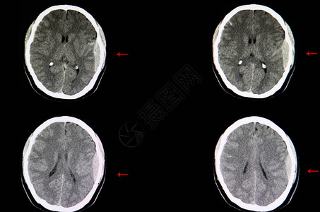 对交通事故病人的脑部进行CT扫描图片