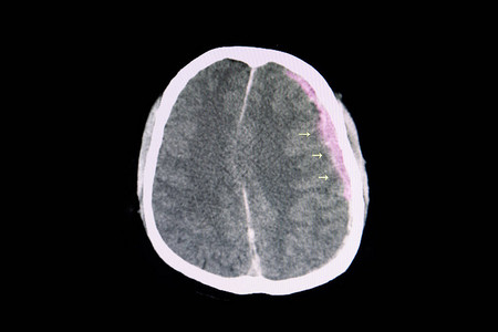 交通事故患者脑部CT扫描显示左脑半球蛛网膜下腔大图片