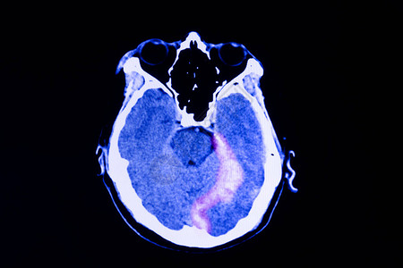显出某种程度的脑水肿导致腹腔内出血高清图片