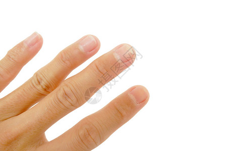 在白色背景下分离的指甲上出现真菌疾病的指甲图片