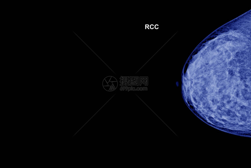 40岁以上女特殊乳房X光检查图像图片