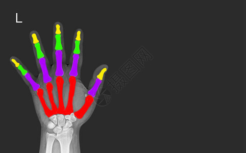 X射线手骨解剖颜色代表每根手指的类型背景