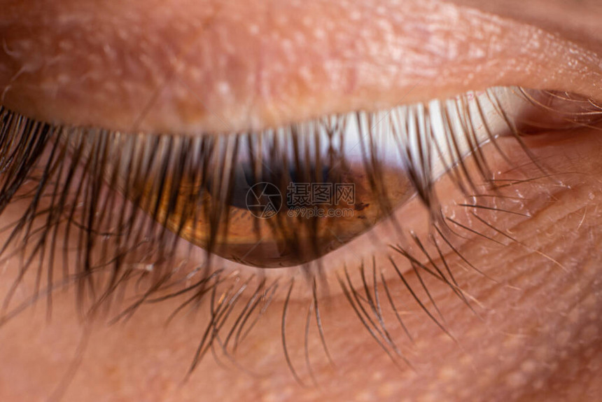 宏观眼睛照片圆锥角膜4度眼部疾病图片