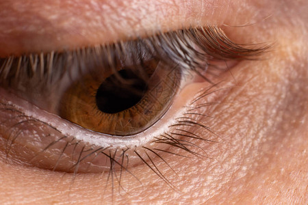 宏观眼睛照片圆锥角膜4度眼部疾病图片