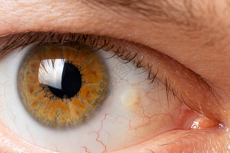 Pinguecula眼睛宏观图片雄眼的近视黄线教育图片