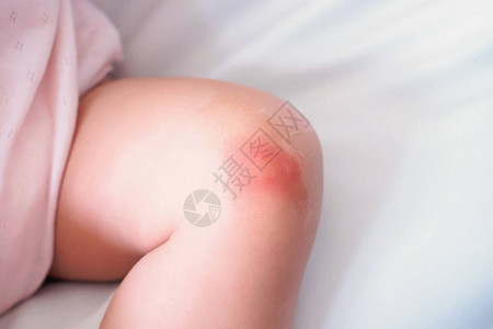 婴儿皮肤疹和过敏因被蚊子咬膝图片
