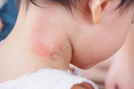 皮肤疹和过敏因被蚊子咬脖子而图片
