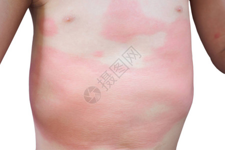 白色背景下超敏反应导致亚洲儿童身体严重湿疹皮和图片