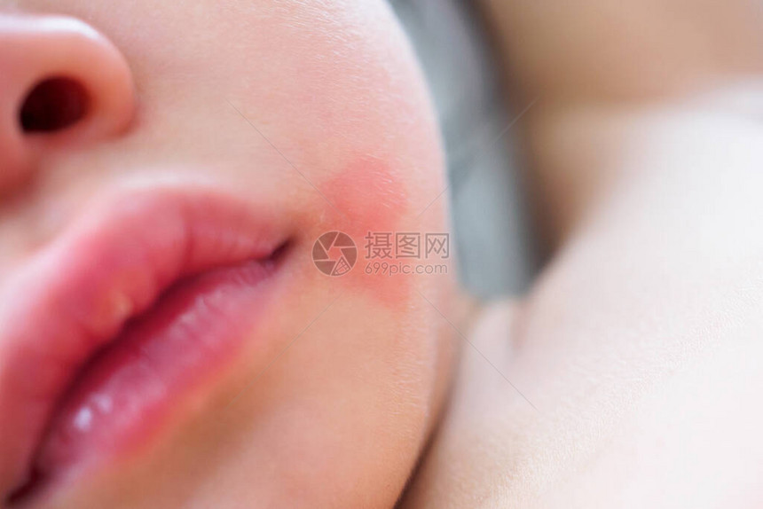 小亚洲女孩皮肤疹和过敏因被蚊子当面图片