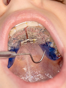 圆钉检查孩子病人的牙套上的牙科医生位置背景
