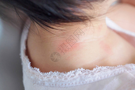 婴儿皮肤疹和过敏因被蚊子咬脖子而图片
