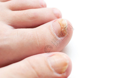 指甲真菌在脚的大脚趾上图片