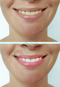 牙齿美白手术前后微笑的女人图片