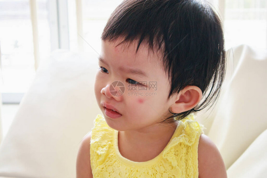 小可爱的亚洲女孩脸部过敏红斑点图片