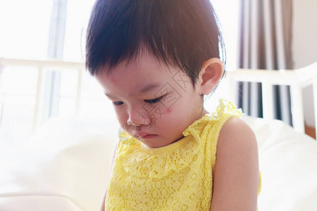 小可爱的亚洲女孩脸部过敏红斑点图片