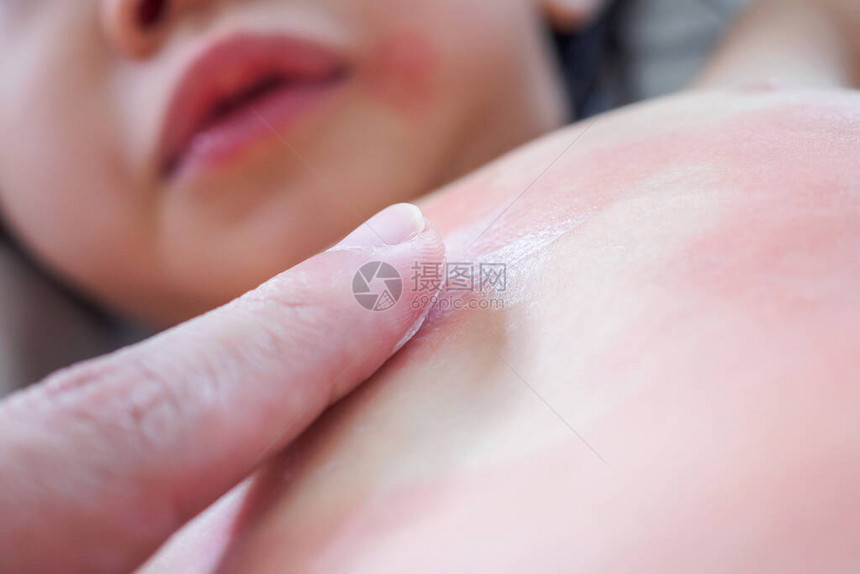 医生的手对皮肤严重皮疹和过敏的小女孩身体施用抗图片