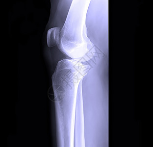 人体腿骨X光片图片