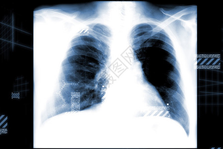 黑色背景上的男胸部x射线图片