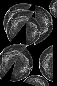 女乳房的侧位乳房X线照片在更高的放大倍数下图片