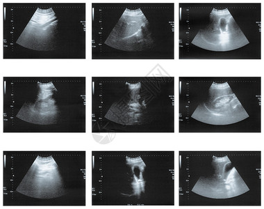 腹部诊断凝结石的超声图片