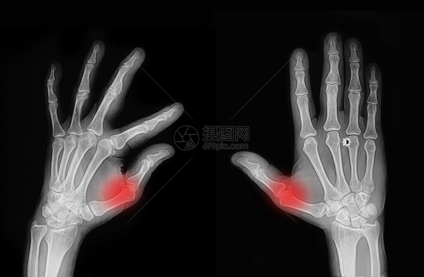 X光手和手指图片